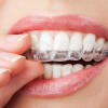 5 Things to Know Before Getting Invisalign Invisalign