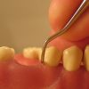 Do I Have Periodontal Disease? Periodontal disease