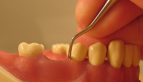 Periodontal disease