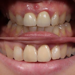 Cosmetic Dentistry in Puyallup, WA - Crown Lengthening, before and after images.