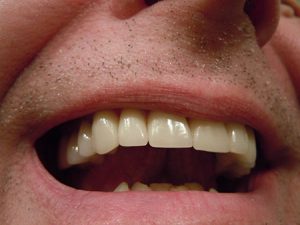 Dental Crowns Puyallup