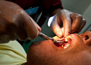 extraction-procedure