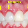 Anything You Need to Know About Gingivitis gingivitis