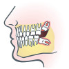 When Do You Need to Remove Your Wisdom Teeth? impacted-wisdom-teeth-photo2